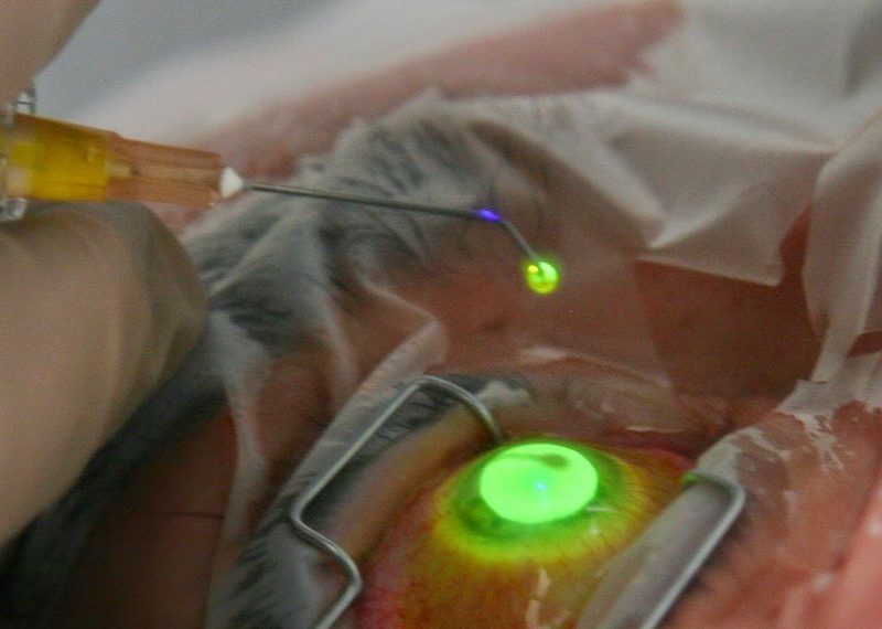 El Madariaga es el hospital con más donantes de córneas del país