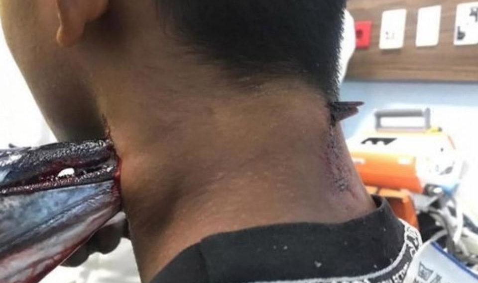Un pez espada apuñaló en el cuello a un joven