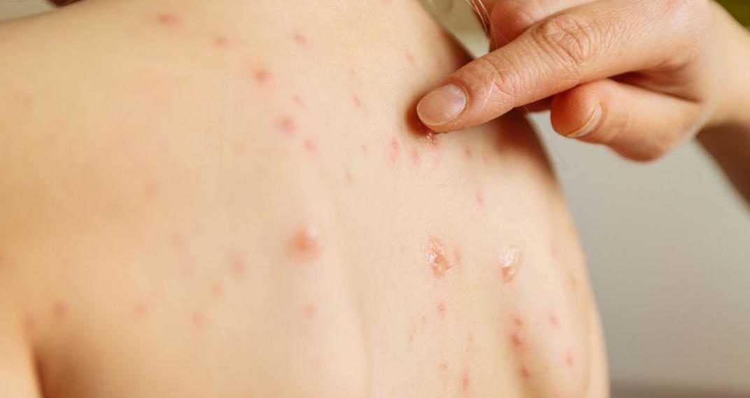 Salud: Argentina está en riesgo de dejar de ser “país libre de sarampión” si el brote continúa