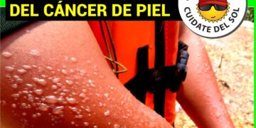 Finaliza Campaña de Prevención del Cáncer de Piel 2020