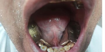 Capturaron en India, a dos hombres por contrabando de oro: lo tenían escondido entre los dientes