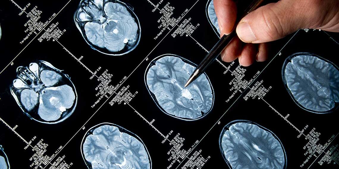 Un software de desarrollo argentino podría diagnosticar de forma precoz el Alzheimer