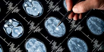 Un software de desarrollo argentino podría diagnosticar de forma precoz el Alzheimer