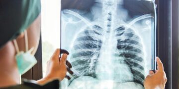 Para reducir la incidencia y mortalidad del cáncer de pulmón estudian la creación de un programa provincial específico