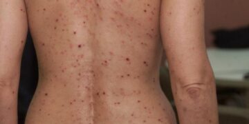 Confirman 24 casos de viruela del mono en Argentina
