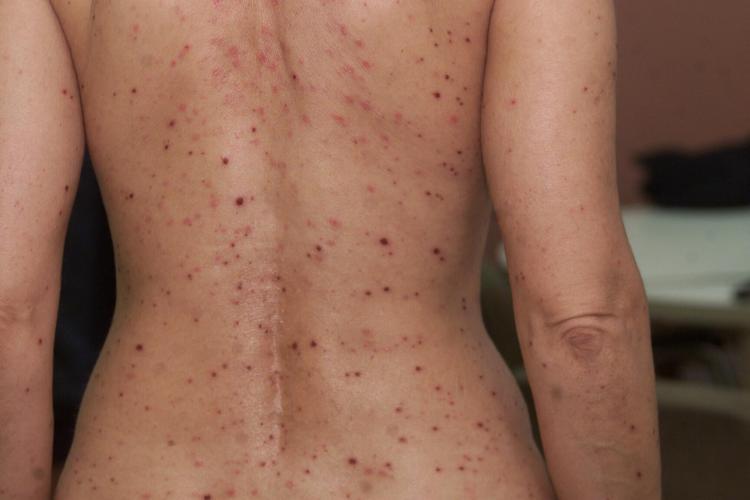 Confirman 24 casos de viruela del mono en Argentina