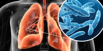 Tucumán: ya son seis las víctimas fatales por Legionella