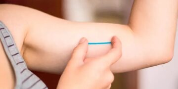 El implante subdérmico anticonceptivo creció más de 1.500% en ocho años