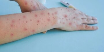 Confirmaron siete nuevos casos de viruela del mono en Argentina