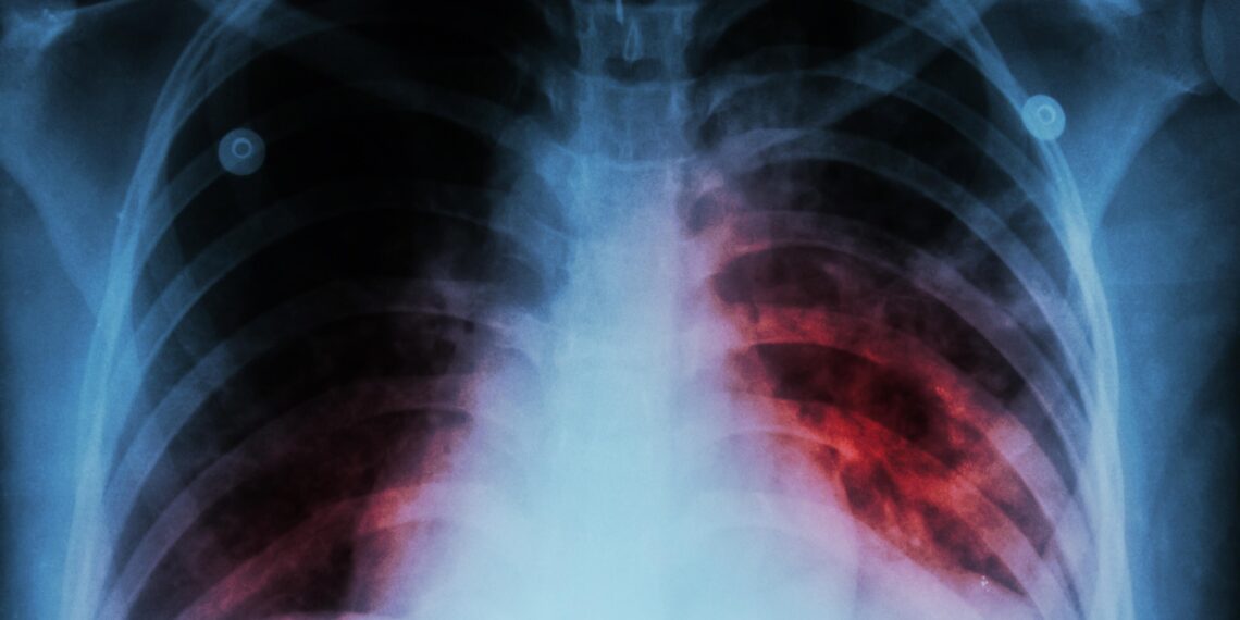 Detuvieron a cuatro personas con tuberculosis que se negaron al tratamiento y contagiaron a menores