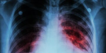 Detuvieron a cuatro personas con tuberculosis que se negaron al tratamiento y contagiaron a menores