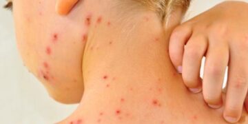 Paraguay confirmó un caso de sarampión tras 10 años de eliminación del virus