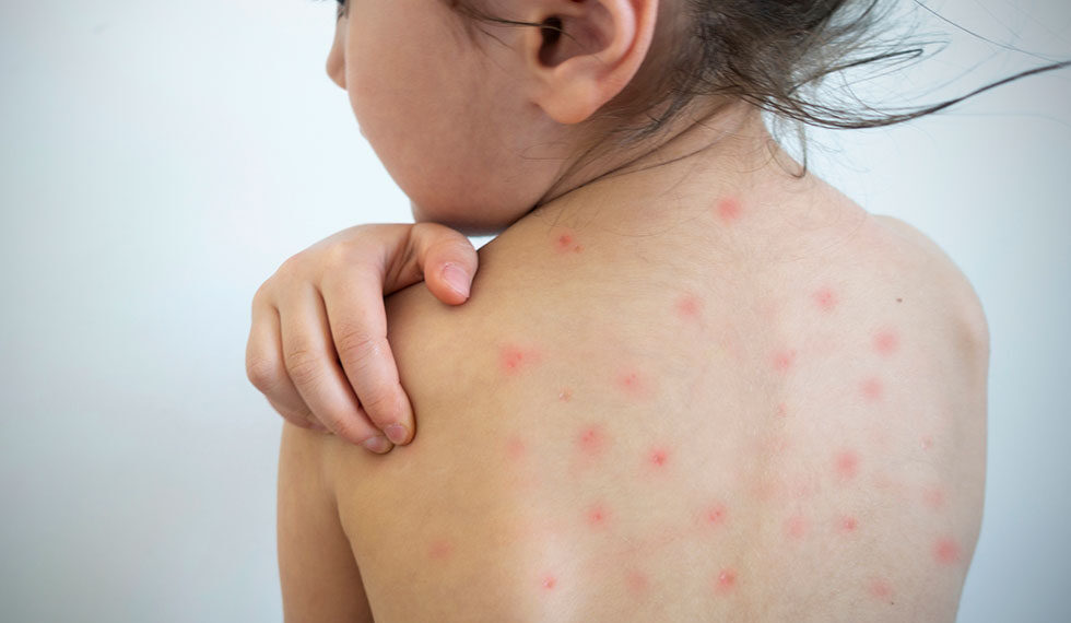 Misiones refuerza la vigilancia epidemiológica ante un brote de sarampión en Paraguay