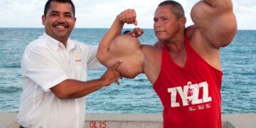 Murió “Popeye”, el fisicoculturista brasileño que se inyectaba aceite para tener unos bíceps de 73 centímetros