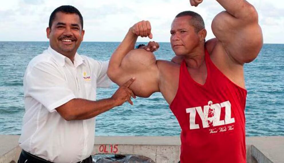Murió “Popeye”, el fisicoculturista brasileño que se inyectaba aceite para tener unos bíceps de 73 centímetros