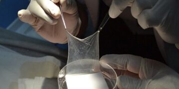 El Madariaga usa tejidos humanos para salvar grandes quemados y acorta a la mitad el tiempo de internación