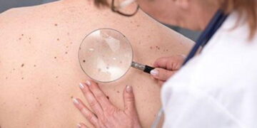 Cáncer de piel: anuncian resultados positivos de una vacuna contra la enfermedad