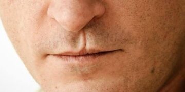 Misiones aprobó un programa para acompañar a pacientes con labio leporino